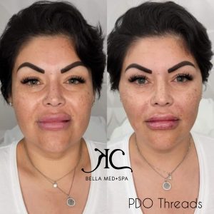 PDO Threads at at Bella Medical Spa, Tempe, AZ, skin rejuvenation and thickening after extreme weight loss. 
