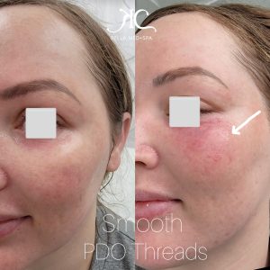 Smooth PDO Threads at at Bella Medical Spa, Tempe, AZ, skin rejuvenation and thickening after extreme weight loss. 
